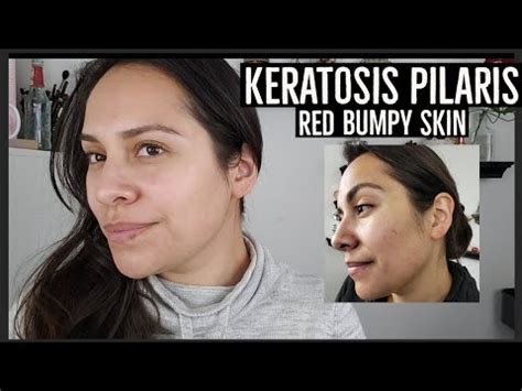 KERATOSIS PILARIS ON FACE - RED BUMPS/CHICKEN SKIN - HOW I MANAGE ...