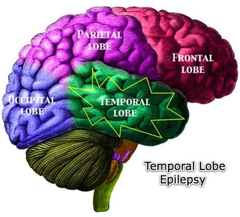 Types of Epileptic Seizures - HubPages