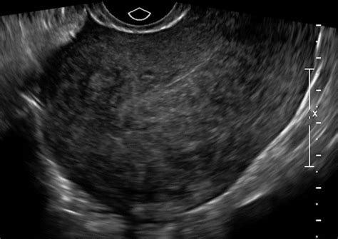 Adenomyosis: A Sonographic Diagnosis | RadioGraphics