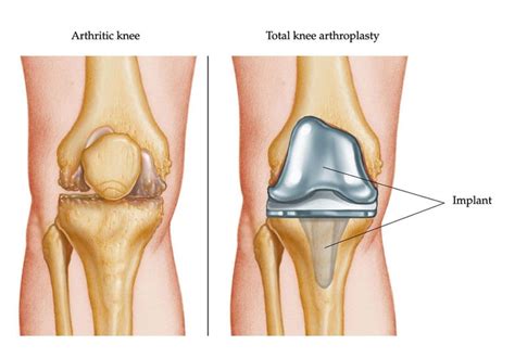 Obesity and total joint arthroplasty - Mayo Clinic