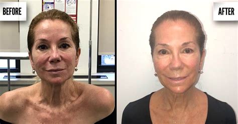 Kathie Lee Gifford reveals the laser skin treatment that helps her keep a youthful look | Laser ...