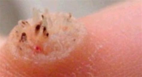 Pin on Warts