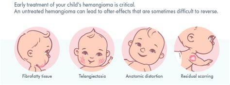 What Is Infantile Hemangioma - Hemangeol