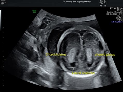 Choroid plexus cyst (CPC) - HKOG-INFO