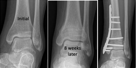 Stress Fracture X Ray Tibia