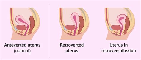 Different posititions of the uterus