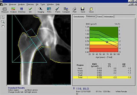 Why and how to measure bone density. Who should have a dexa scan