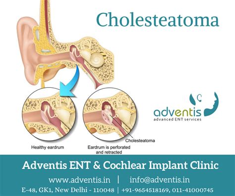 Cholesteatoma Definition, Symptoms, Complications And, 50% OFF