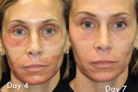 Laser Resurfacing Photos | Miami, FL | Patient 6051