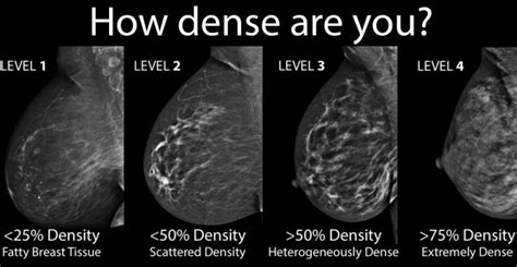 Symptoms of Stage 4 Breast cancer