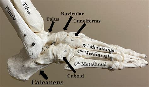 Calcaneus Fracture (Broken Heel Bone) | Orthopaedic Trauma Association (OTA)