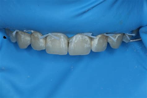 White Spot Lesions: Treatment With Resin Infiltration - Dentistry Today