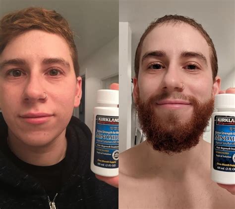 Minoxidil timeline after 2 years of on and off use [3.5 yrs on T] : r/FTMfacialhair