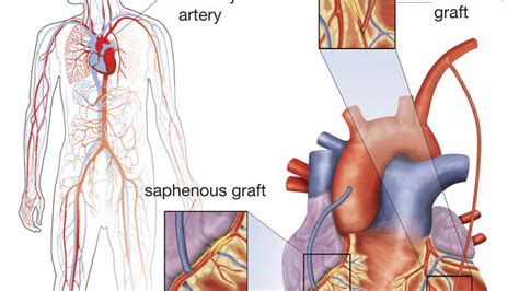 Cardiovascular disease - Coronary artery bypass surgery | Britannica