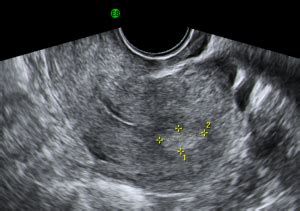 Chapter 6 – Endometrial polyps – Melaka Fertility