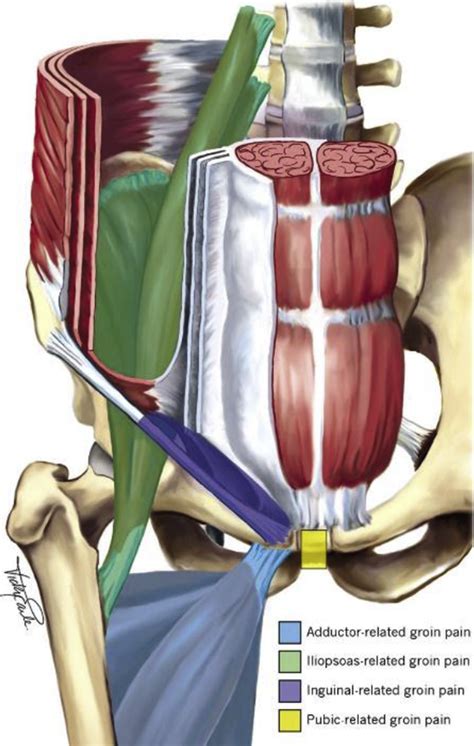 Imaging Athletic Groin Pain - Radiologic Clinics