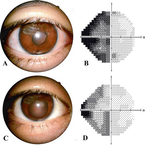 Postoperative mydriatic reaction and the visual field of the right eye ...