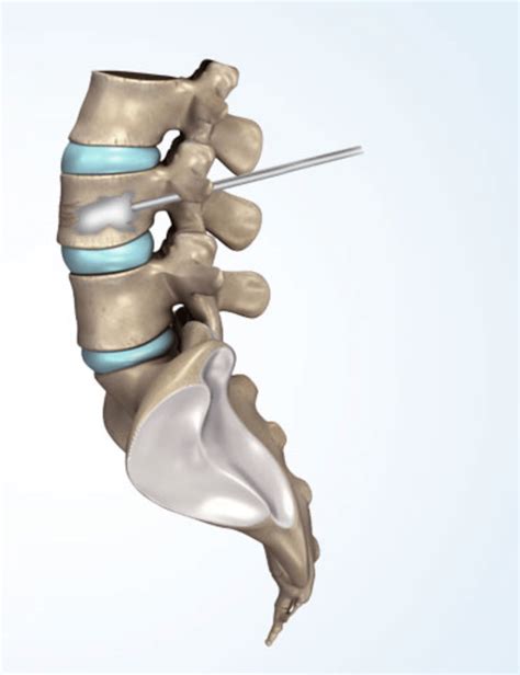 VERTEBROPLASTY AND KYPHOPLASTY - Texas Spine Care Center