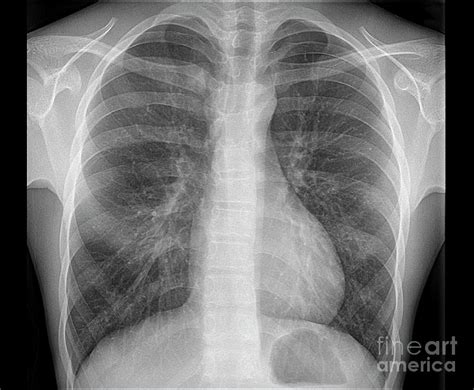 Healthy Lungs Photograph by Zephyr/science Photo Library