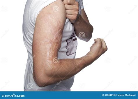 Scar on His Forearm, Scalding with Boiling Water Stock Photo - Image of muscles, cylinder: 81084218