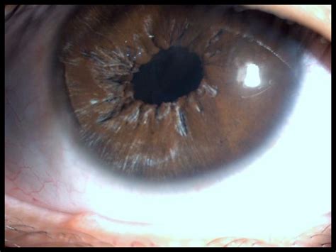 Complex Anterior Segment Surgery - Eagle Eye Centre