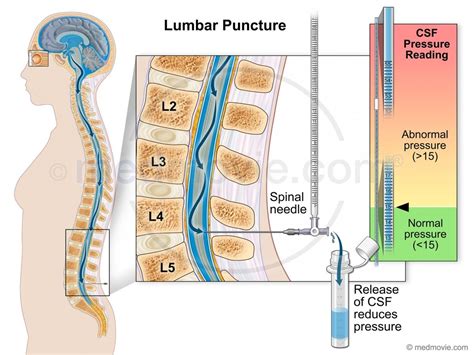 Lumbar Puncture – Medmovie.com