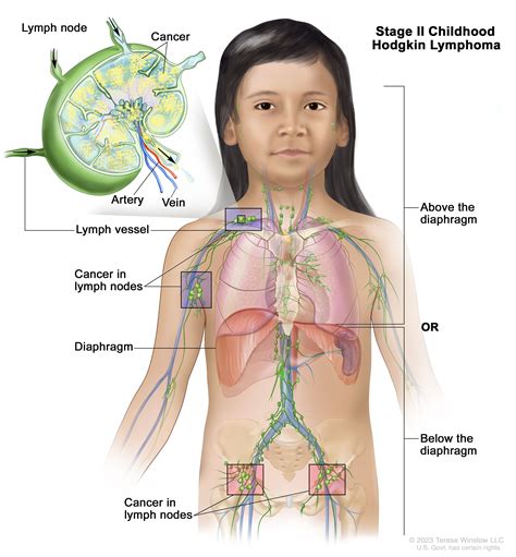 Childhood Hodgkin Lymphoma Treatment (PDQ®)–Patient Version - Siteman ...