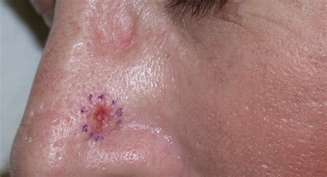 Bump On Nose Skin Cancer