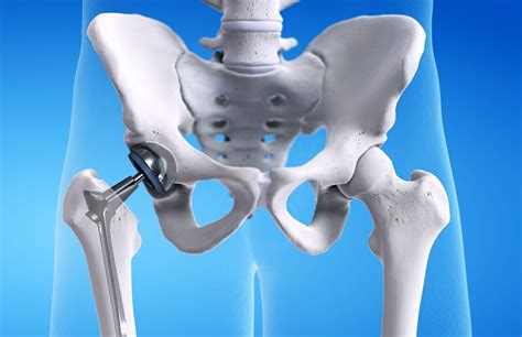 What Your Hip Replacement Implants Are Made Of · Health Vantis