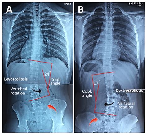 √1000以上 dextroscoliosis vs levoscoliosis 258222-Dextroscoliosis and ...