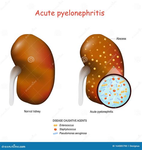 [DIAGRAM] Diagram Of Pyelonephritis - MYDIAGRAM.ONLINE