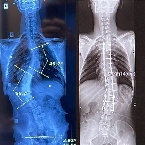 Guess who else has scoliosis....? Usain Bolt, the fastest man in the world! : scoliosis