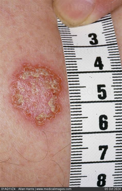 STOCK IMAGE, dermatology infected eczema red round and crusty patcheson the leg of a 67 year old ...