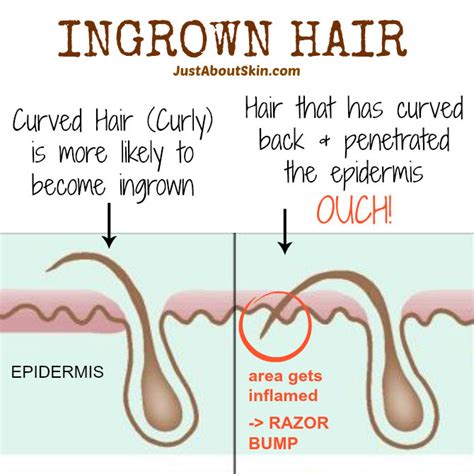 Tips for Preventing Ingrown Hairs - Just About Skin