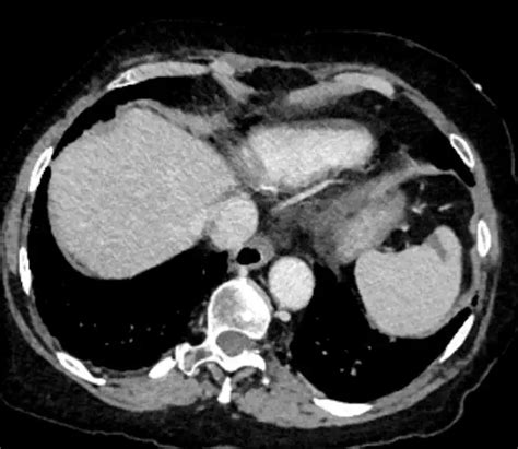 Pulmonary Embolism Symptoms