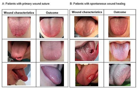 Tongue lacerations in children: to suture or not?