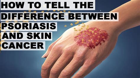 How to tell the difference between psoriasis and skin cancer. - YouTube