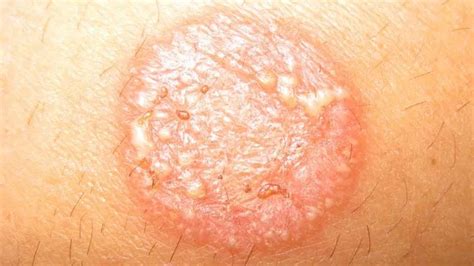 What To Do If Infected With Ringworm? - Thinking About Health