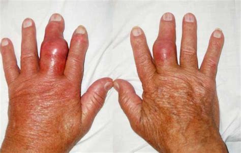 Gout disease pictures, signs of gout pictures, gout symptoms pictures ...