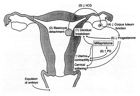 Mifepristone (RU 486) -- A Modulator of Progestin and Glucocorticoid Action | NEJM