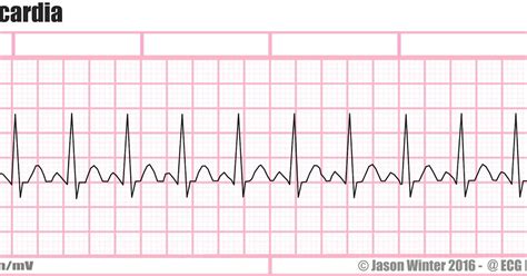 ECG Educator Blog : Sinus Tachycardia