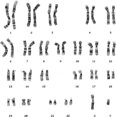 Disorders With Chromosome Abnormalities Plastic Surgery Key