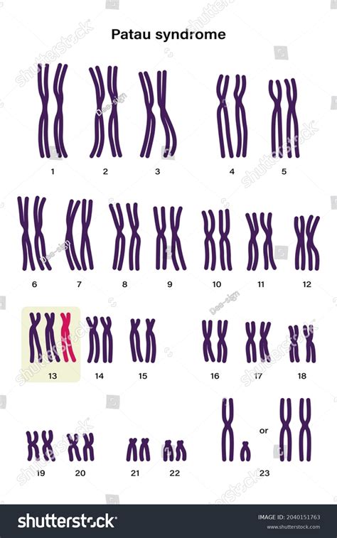 Human Karyotype Patau Syndrome Autosomal Abnormalities Stock Vector (Royalty Free) 2040151763 ...