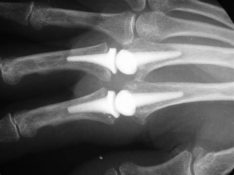 Reconstruction: Pyrolytic carbon metacarpophalangeal joint implant ...