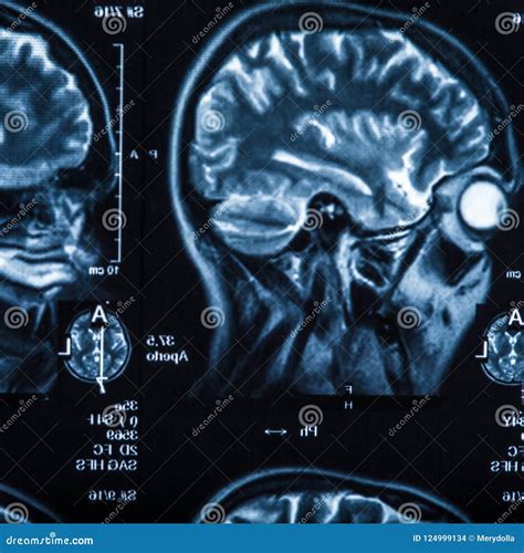 The X-ray of the Human Brain Stock Photo - Image of radiology, resonance: 124999134