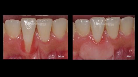 Receding Gums Cases - Southern Delaware Dental Specialists