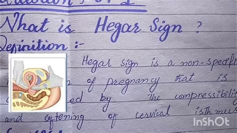 Hegar's sign//sign of pregnancy//Us medicos - YouTube