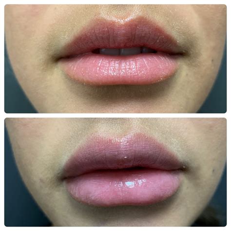 Lip Augmentation Surgery | Risk | Complications | Cost | Before and After