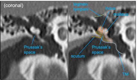 Prussak Space Ct Scan