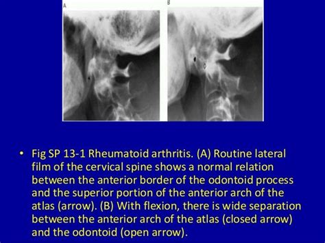 13 atlantoaxial subluxation